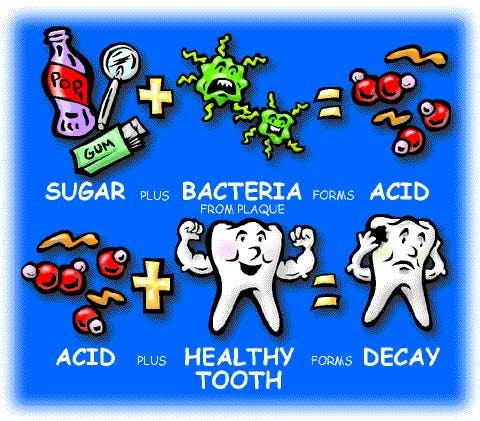 Tooth Decay Fo
