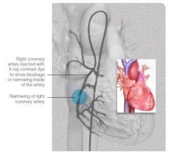 Coronary Artery Fo