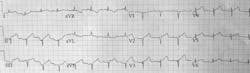 Electrocardiogram Fo