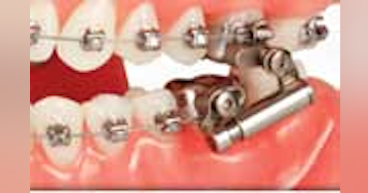 AdvanSync2 increases treatment efficiency | Dentistry IQ