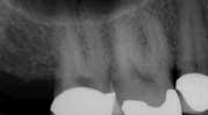 There Is More Than One Way To Skin A Cat Deciding Which Endodontic File Will Achieve The Best Clinical Outcome Dentistryiq