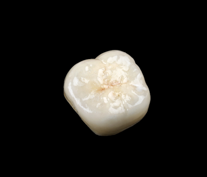 Content Dam Diq Online Articles 2015 01 Ceramic Crown