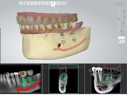 Content Dam Diq Online Articles 2015 02 Implant Softwarethumbnail Content Dam Diq Online Articles 2015 02 Implant Softwarethumbnail