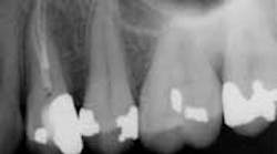 Content Dam Diq Online Articles 2015 03 15apr2bclandwehr Rootcanals 03b Article Thumbnail Content Dam Diq Online Articles 2015 03 15apr2bclandwehr Rootcanals 03b Article Thumbnail