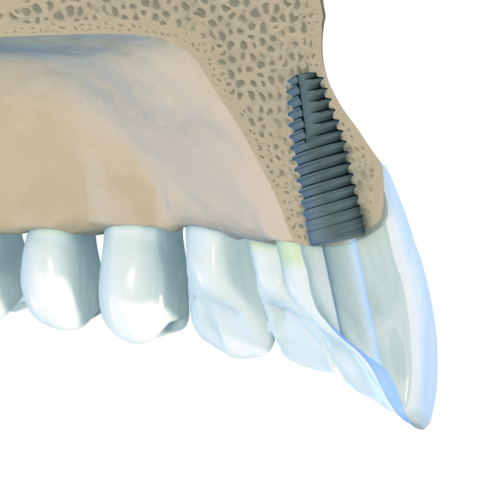 Straumann Introduces A Tapered Implant For Immediate Placement And Loading Dentistryiq