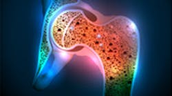 Content Dam Diq Online Articles 2015 04 Osteoporosis Hip Joint Diq Content Dam Diq Online Articles 2015 04 Osteoporosis Hip Joint Diq