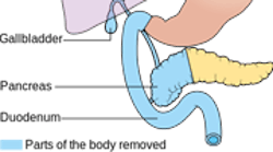 Content Dam Diq Online Articles 2015 04 Whipple Proceedure Content Dam Diq Online Articles 2015 04 Whipple Proceedure