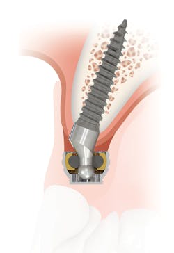 Content Dam Diq Online Articles 2015 04 Zest Saturno Angled Maxilla Content Dam Diq Online Articles 2015 04 Zest Saturno Angled Maxilla