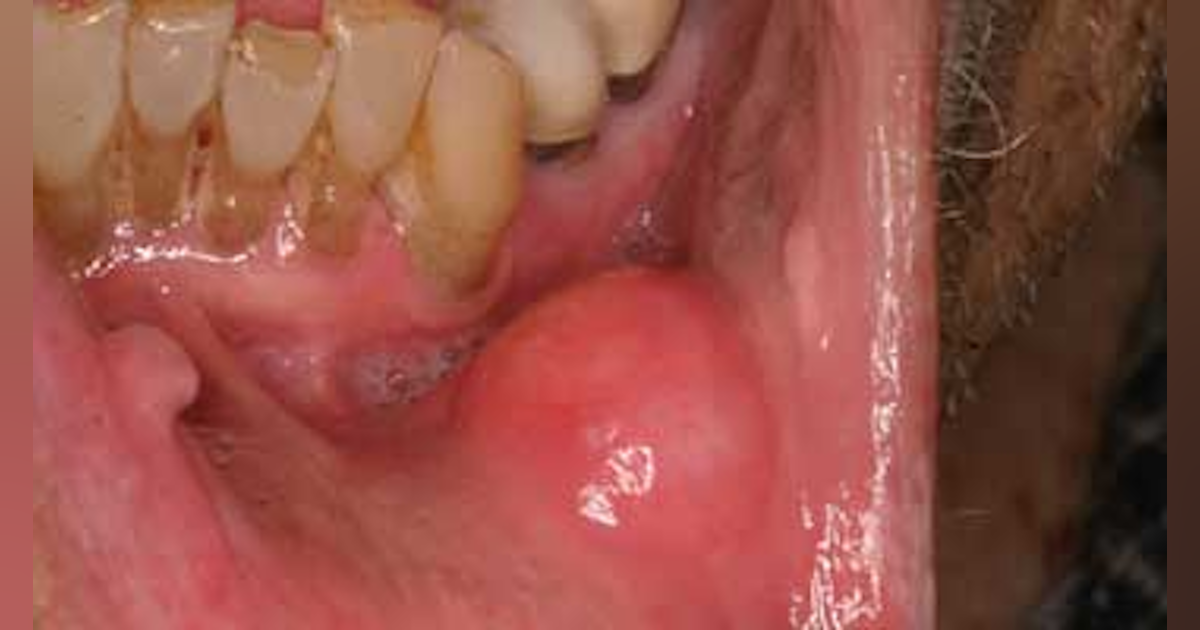 hpv mouth cancer treatment