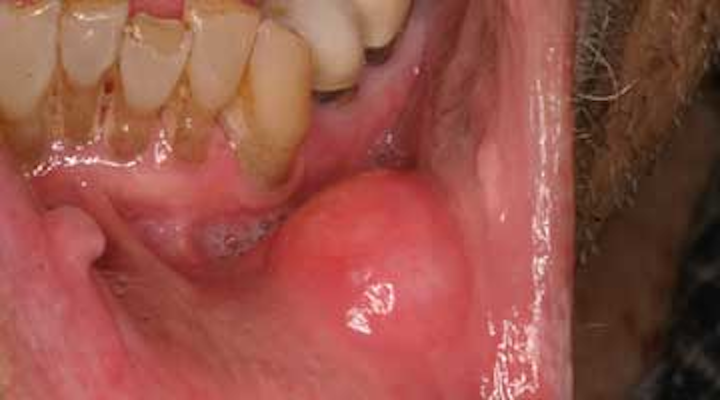 Hpv in mouth signs Hpv in throat symptoms. Hpv mouth and throat symptoms
