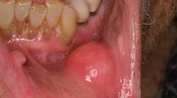 Content Dam Diq Online Articles 2015 05 15may28srrfroum Oralcancer Article Thumbnail Content Dam Diq Online Articles 2015 05 15may28srrfroum Oralcancer Article Thumbnail