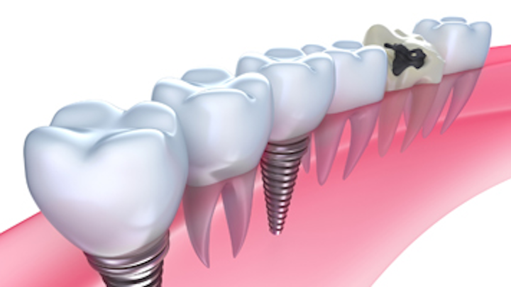 Content Dam Diq Online Articles 2015 06 Implants In Gum Thumb
