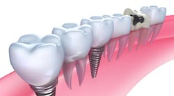Content Dam Diq Online Articles 2015 06 Implants In Gum Thumb Content Dam Diq Online Articles 2015 06 Implants In Gum Thumb