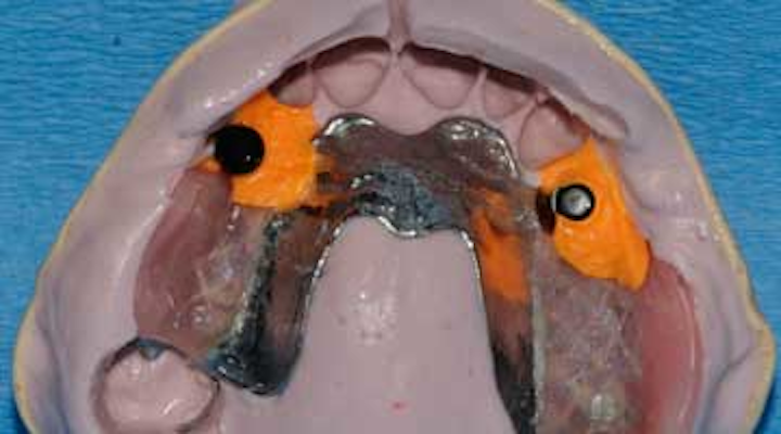 Claspless Removable Partial Dentures Using Implant Supported Locator Attachments Dentistryiq