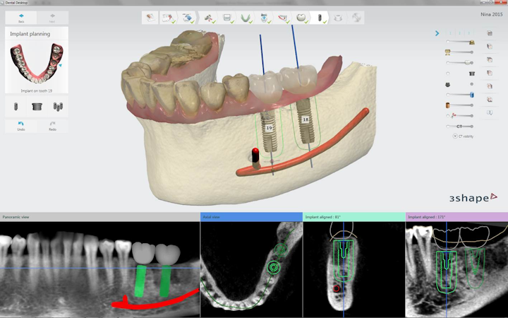 Content Dam Diq Online Articles 2015 07 Implantstudio Dentsply