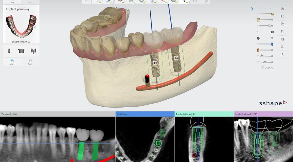 Content Dam Diq Online Articles 2015 07 Implantstudio Dentsply