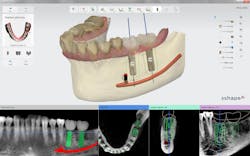 Content Dam Diq Online Articles 2015 07 Implantstudio Dentsply Content Dam Diq Online Articles 2015 07 Implantstudio Dentsply