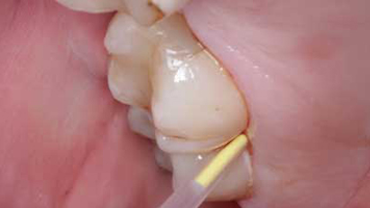 Content Dam Diq Online Articles 2015 07 Periodontitis