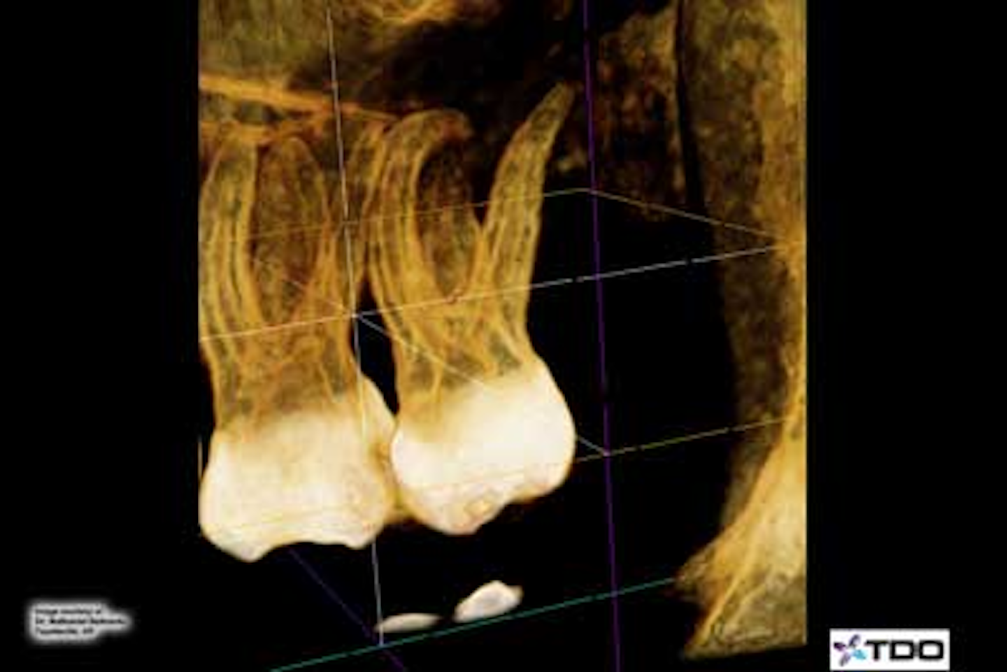 Endodontic case study Hybrid technique on 90degree curve DentistryIQ