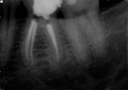 13nov19endolandwehrpostop1 13nov19endolandwehrpostop1