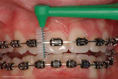 dental brush for braces