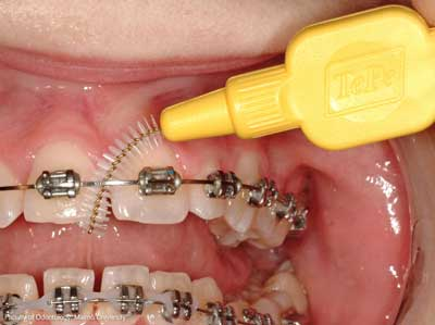 dental brush for braces