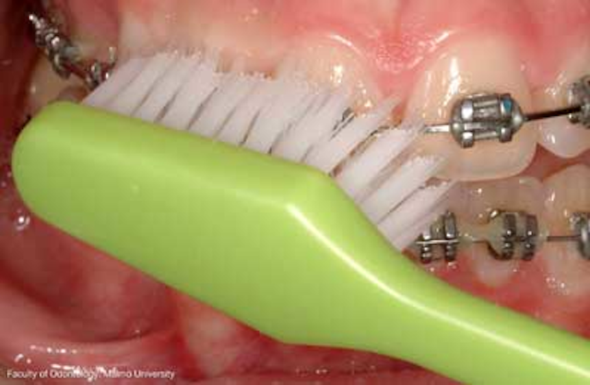 Orthodontic maintenance techniques toothbrushes and interdental