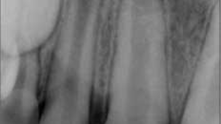 1405endopetrinoregenendo01