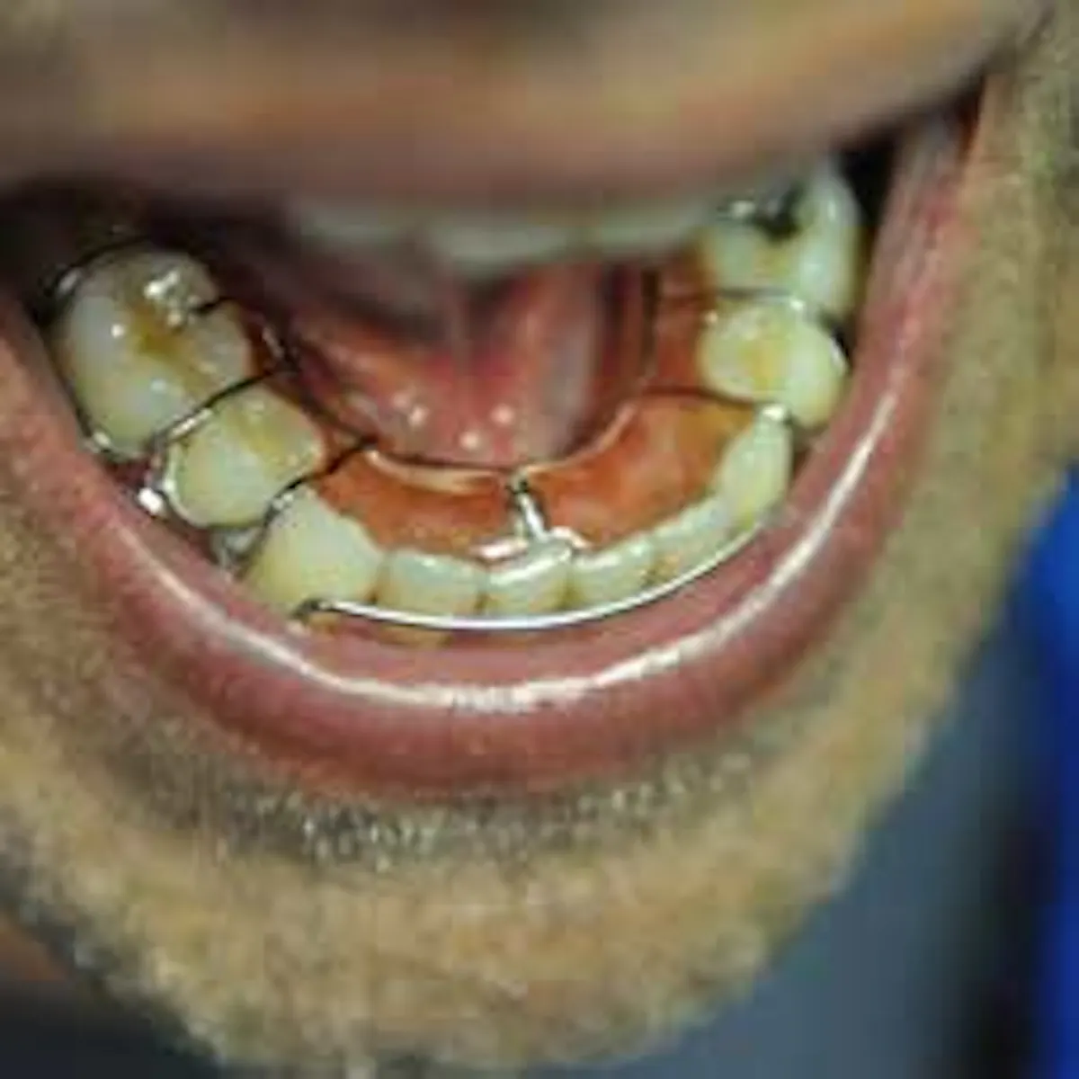 Hawley appliances: what they can do for your dental practice | Dentistry IQ