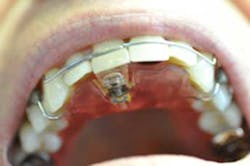 14apr17bfsperronehawley06 14apr17bfsperronehawley06