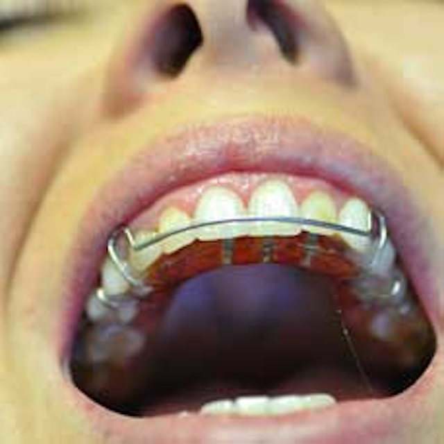 Hawley appliances what they can do for your dental practice DentistryIQ