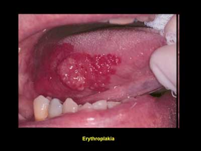human papillomavirus infection dental