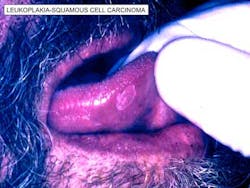 14aprfroumoralcancer03 14aprfroumoralcancer03