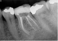 14jul15endobelaniradix02 14jul15endobelaniradix02