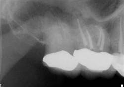 14jul15endolandwehrpostop1 14jul15endolandwehrpostop1