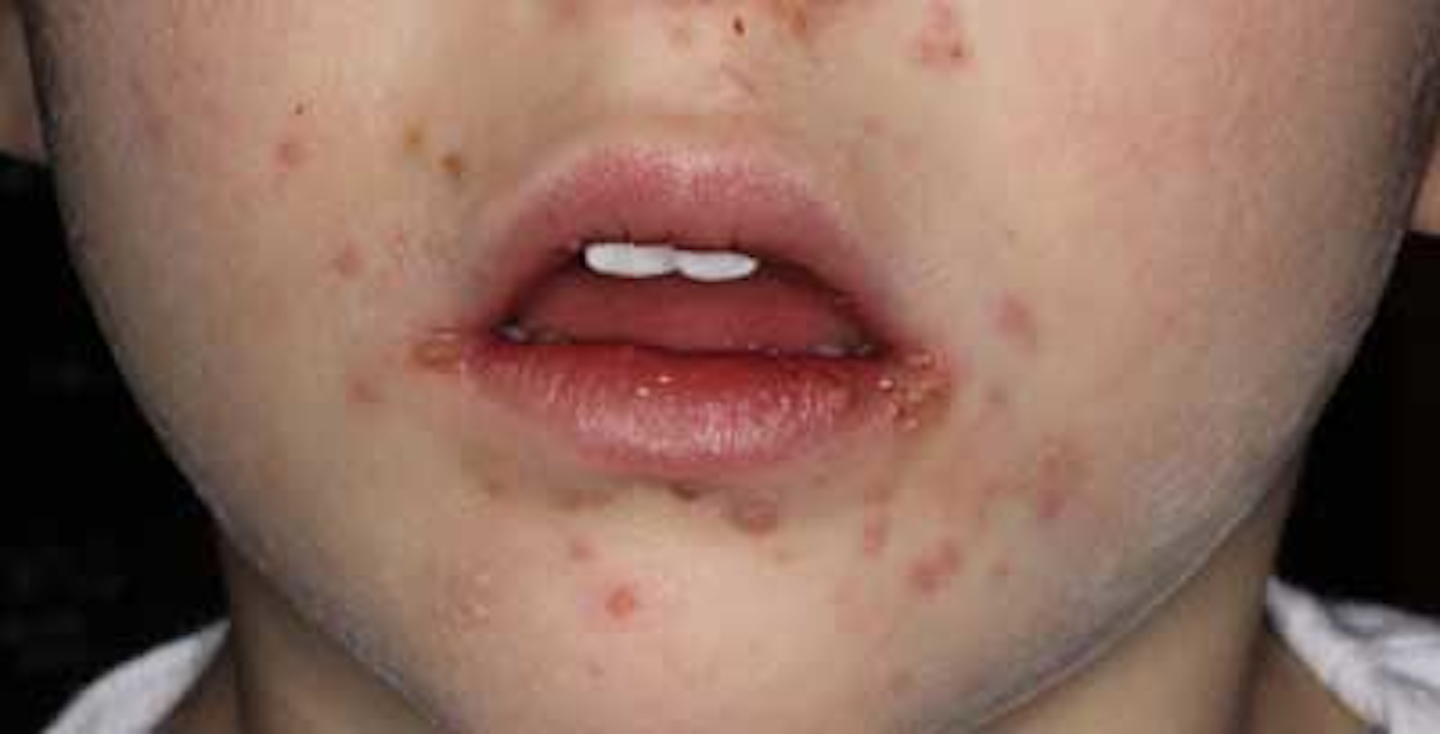 Acute primary herpetic gingivostomatitis: a case report | DentistryIQ