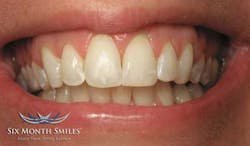 14marbfsperrone6monthsmilesmiaafter 14marbfsperrone6monthsmilesmiaafter