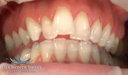 14marbfsperrone6monthsmilesmiabefore 14marbfsperrone6monthsmilesmiabefore