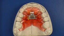 14marbfsperronegreatlakesorthoexpansionplatetomovemultipleteeth 14marbfsperronegreatlakesorthoexpansionplatetomovemultipleteeth
