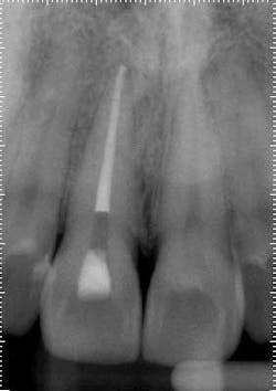 14may20endolandwehrreferredpainpostop 14may20endolandwehrreferredpainpostop