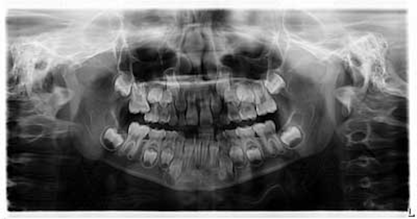 Orthodontic options for the ectopic eruption of a maxillary first molar ...