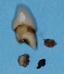 14sept16endosimmons Resorption03 14sept16endosimmons Resorption03