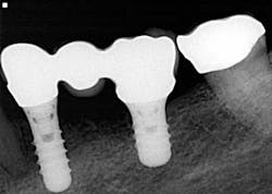 14srrsimmonsdentures10 14srrsimmonsdentures10