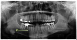 Sialolith of the right submandibular gland Sialolith of the right submandibular gland