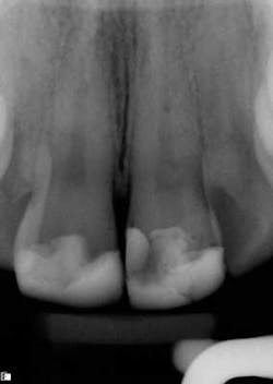15apr2bclandwehr Rootcanals 01a 15apr2bclandwehr Rootcanals 01a