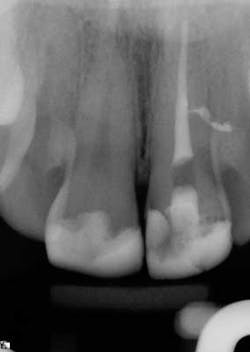 15apr2bclandwehr Rootcanals 01b 15apr2bclandwehr Rootcanals 01b