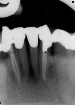 15apr2bclandwehr Rootcanals 02 15apr2bclandwehr Rootcanals 02