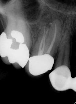 15apr2bclandwehr Rootcanals 03a 15apr2bclandwehr Rootcanals 03a