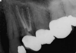 15apr2bclandwehr Rootcanals 03c 15apr2bclandwehr Rootcanals 03c
