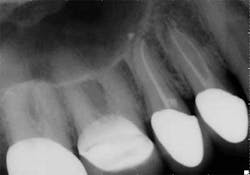15apr2bclandwehr Rootcanals 04a 15apr2bclandwehr Rootcanals 04a